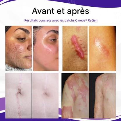 Patchs Régénérants Anti-Cicatrices avec Acide Hyaluronique – Réduction des Cicatrices, Vergetures et Marques Cutanées