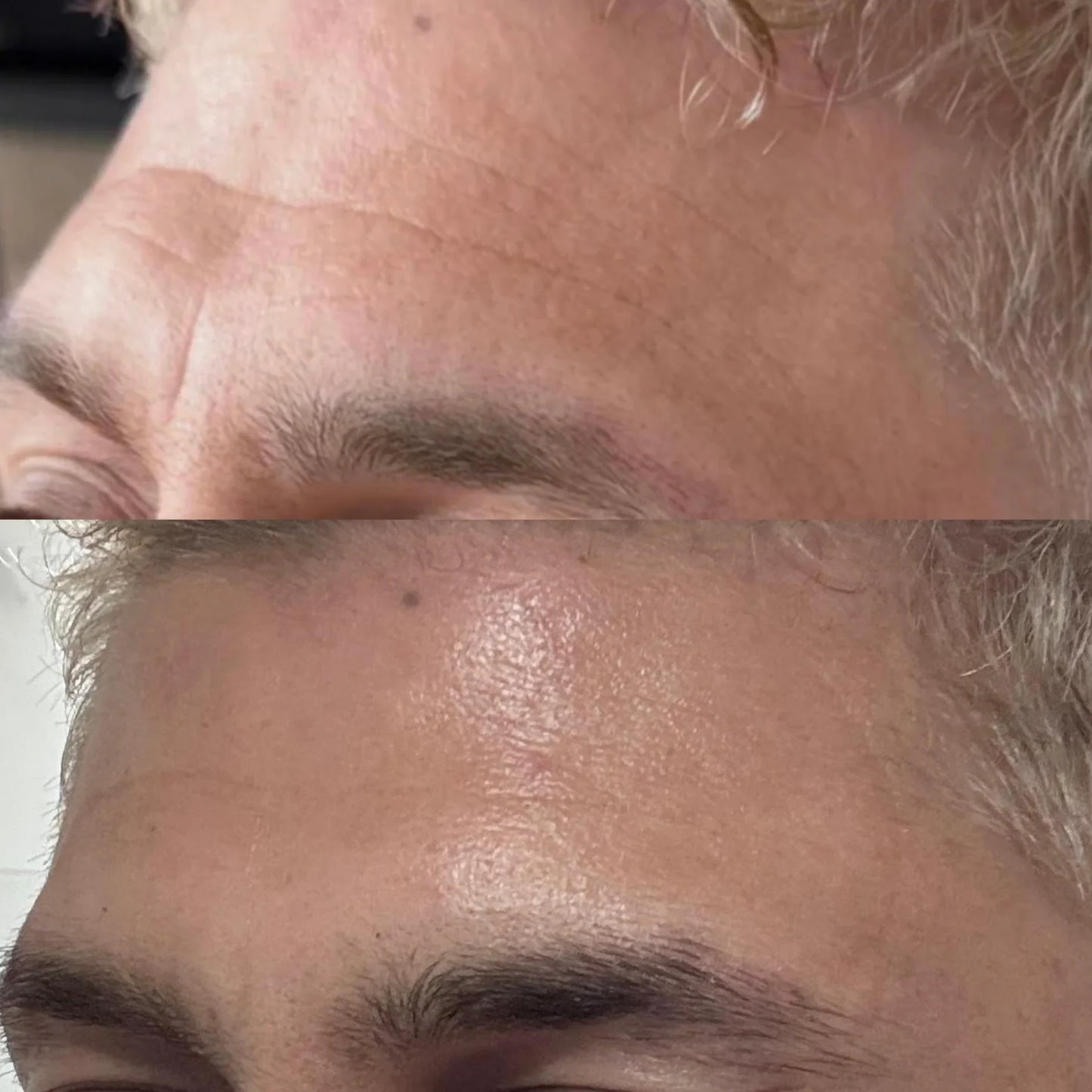 Patchs Visage Anti-Rides Réutilisables